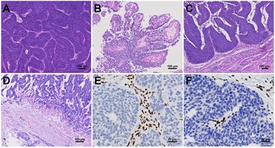 Clinicopathological characteristics, molecular landscape, and biomarker landscape for predicting the efficacy of PD-1/PD-L1 inhibitors in Chinese population with mismatch repair deficient urothelial carcinoma: a real-world study